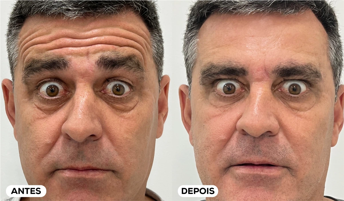 Antes e Depois - Aplicação Toxina Botulínica 11