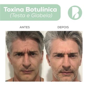 Toxina Botulínica - Exemplo 1