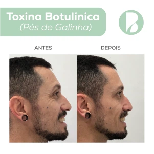 Toxina Botulínica - Exemplo 3